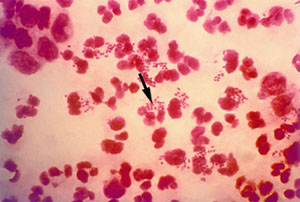 Neisseria gonorrhoeae 