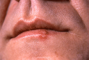 Herpes simplex blister